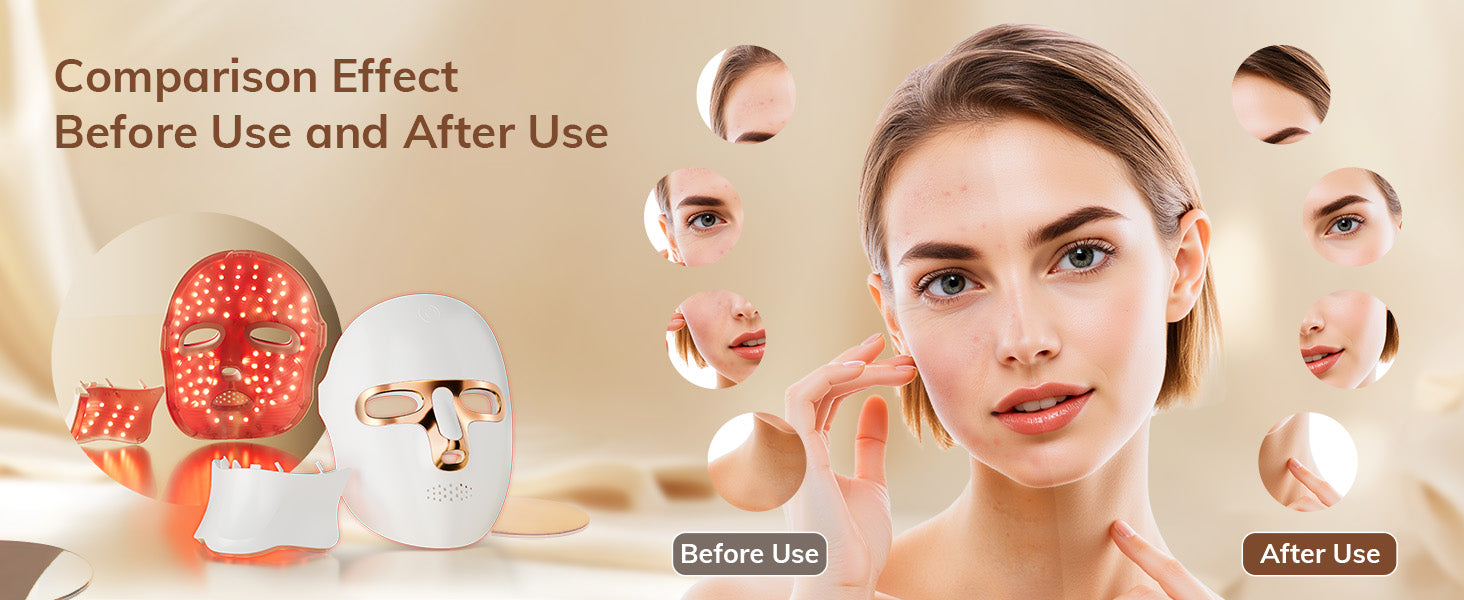 Before and after comparison showing skin improvement and acne reduction after using the ONLUKY LED light therapy mask.